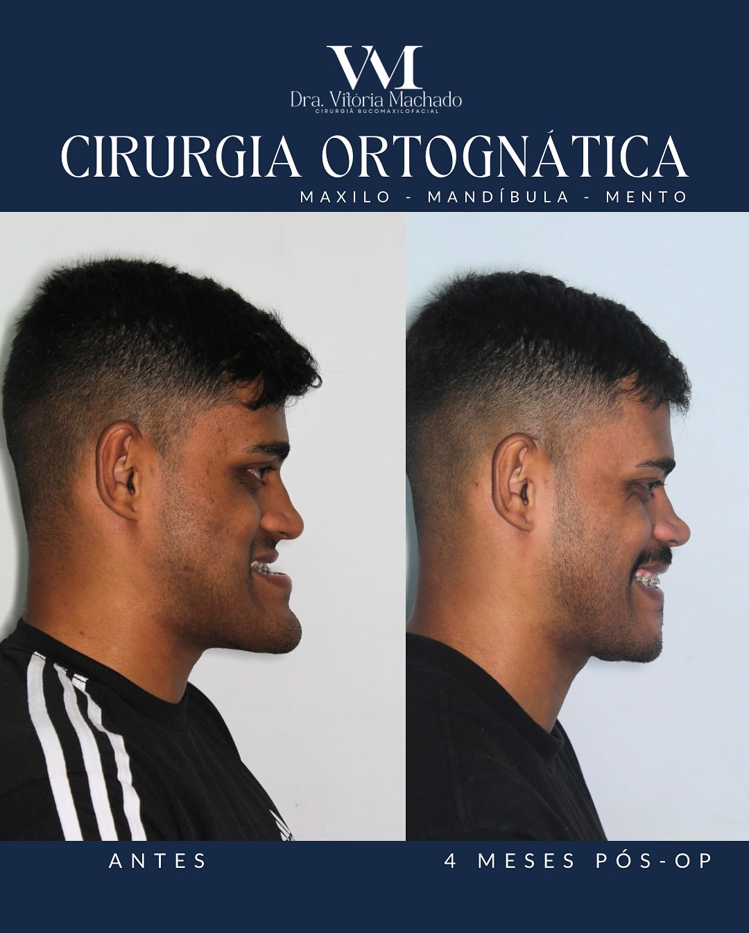 Cirurgia ortognática